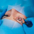 opération hypermétropie rouen