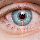 opération myopie rouen